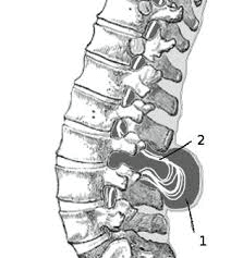 Spina bifida
